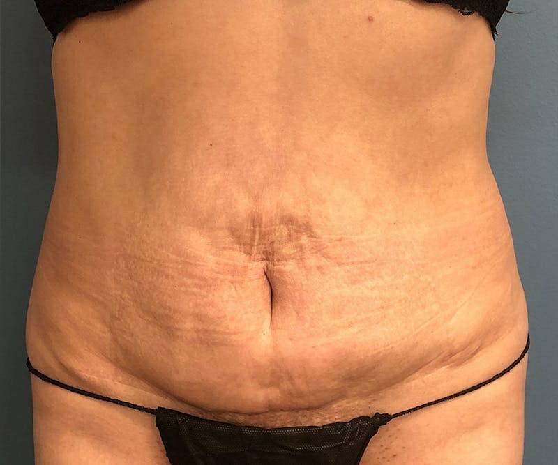 Tummy Tuck Before & After Gallery - Patient 239109 - Image 1