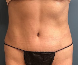 Tummy Tuck Before & After Gallery - Patient 239109 - Image 2