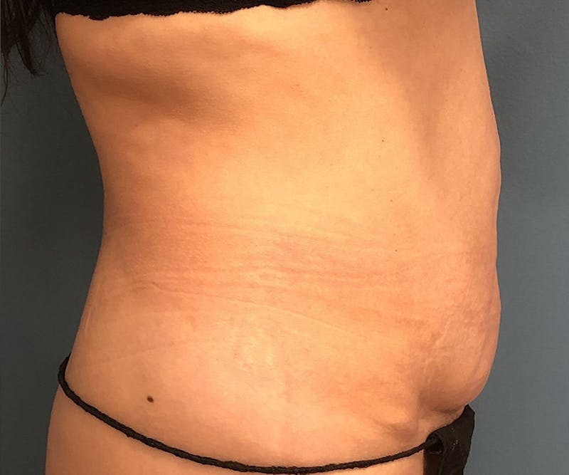 Tummy Tuck Before & After Gallery - Patient 239109 - Image 3