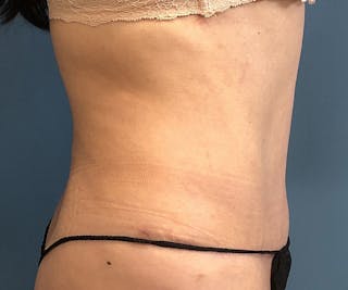 Tummy Tuck Before & After Gallery - Patient 239109 - Image 4