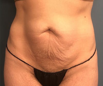 Tummy Tuck Before & After Gallery - Patient 123033 - Image 1