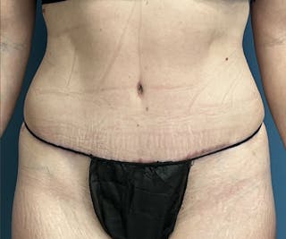 Tummy Tuck Before & After Gallery - Patient 123033 - Image 2
