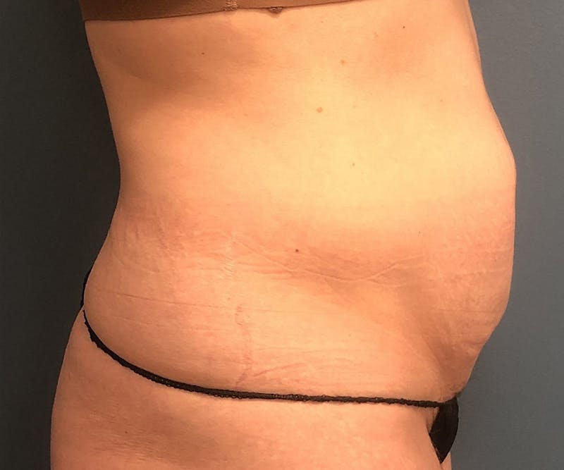 Tummy Tuck Before & After Gallery - Patient 123033 - Image 3