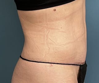 Tummy Tuck Before & After Gallery - Patient 123033 - Image 4