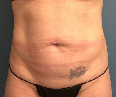 Tummy Tuck Before & After Gallery - Patient 138160 - Image 1