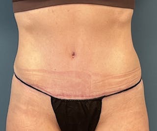 Tummy Tuck Before & After Gallery - Patient 138160 - Image 2