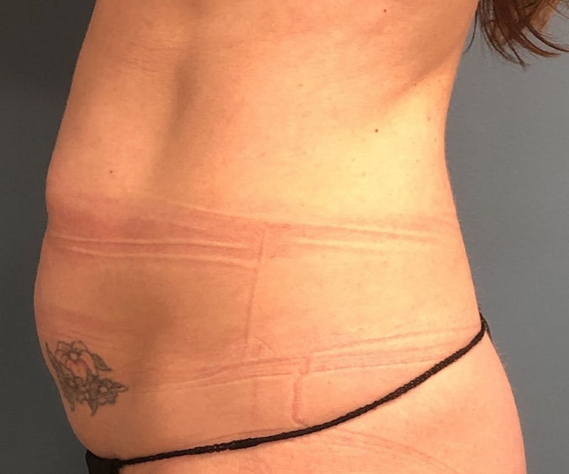 Tummy Tuck Before & After Gallery - Patient 138160 - Image 3