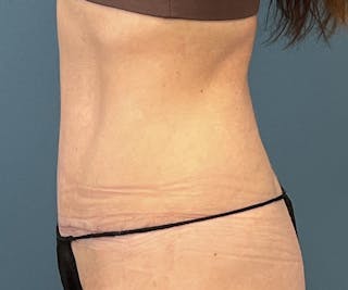 Tummy Tuck Before & After Gallery - Patient 138160 - Image 4