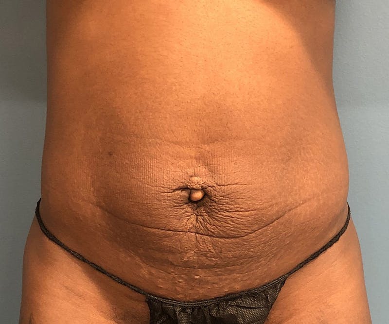 Tummy Tuck Before & After Gallery - Patient 246191 - Image 1