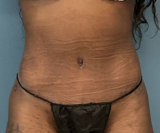 Tummy Tuck Before & After Gallery - Patient 246191 - Image 2