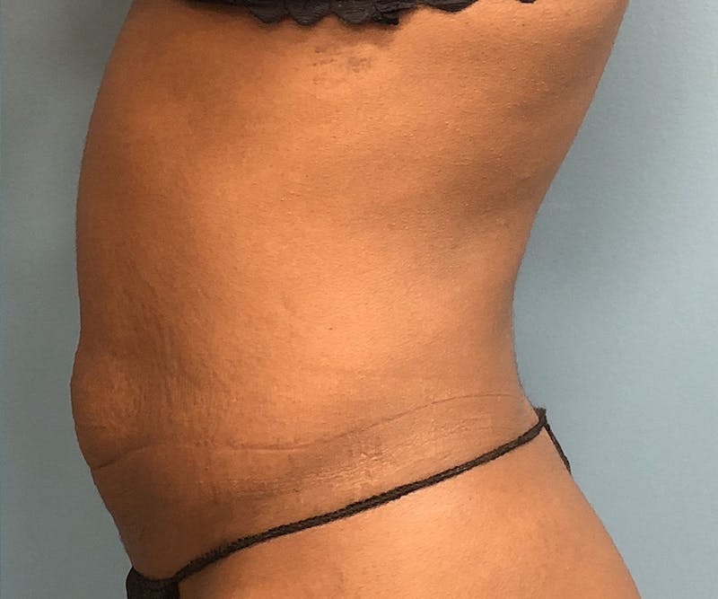 Tummy Tuck Before & After Gallery - Patient 246191 - Image 3