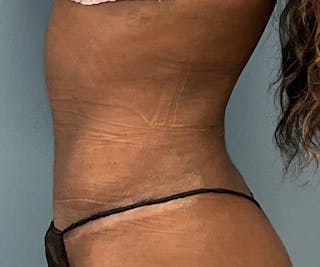 Tummy Tuck Before & After Gallery - Patient 246191 - Image 4