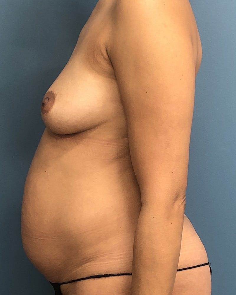 Mommy Makeover Before & After Gallery - Patient 366987 - Image 3