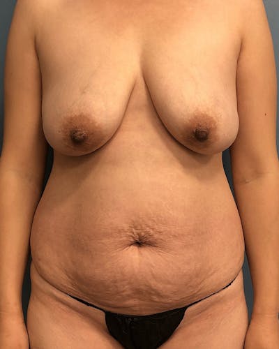 Mommy Makeover Before & After Gallery - Patient 188981 - Image 1