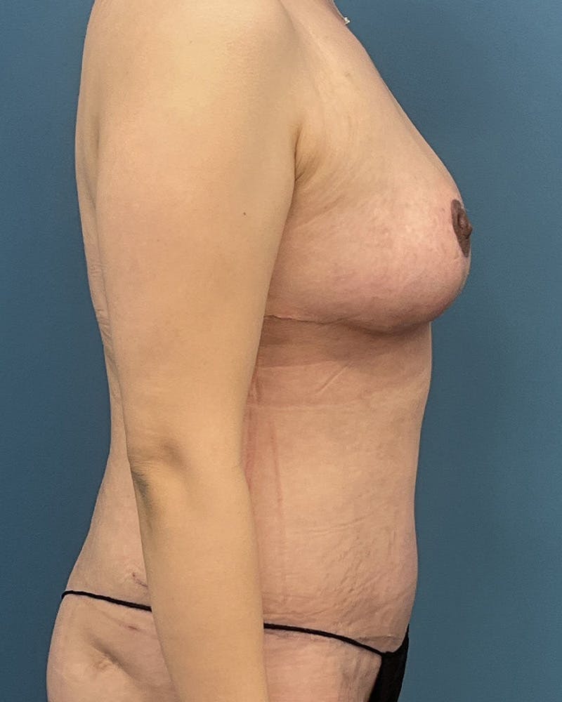 Mommy Makeover Before & After Gallery - Patient 188981 - Image 4