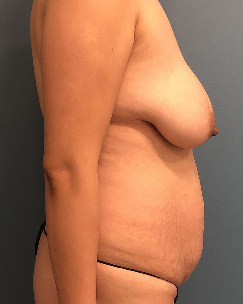 Mommy Makeover Before & After Gallery - Patient 188981 - Image 3