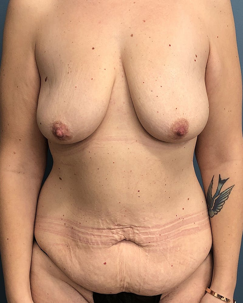 Mommy Makeover Before & After Gallery - Patient 104356 - Image 1