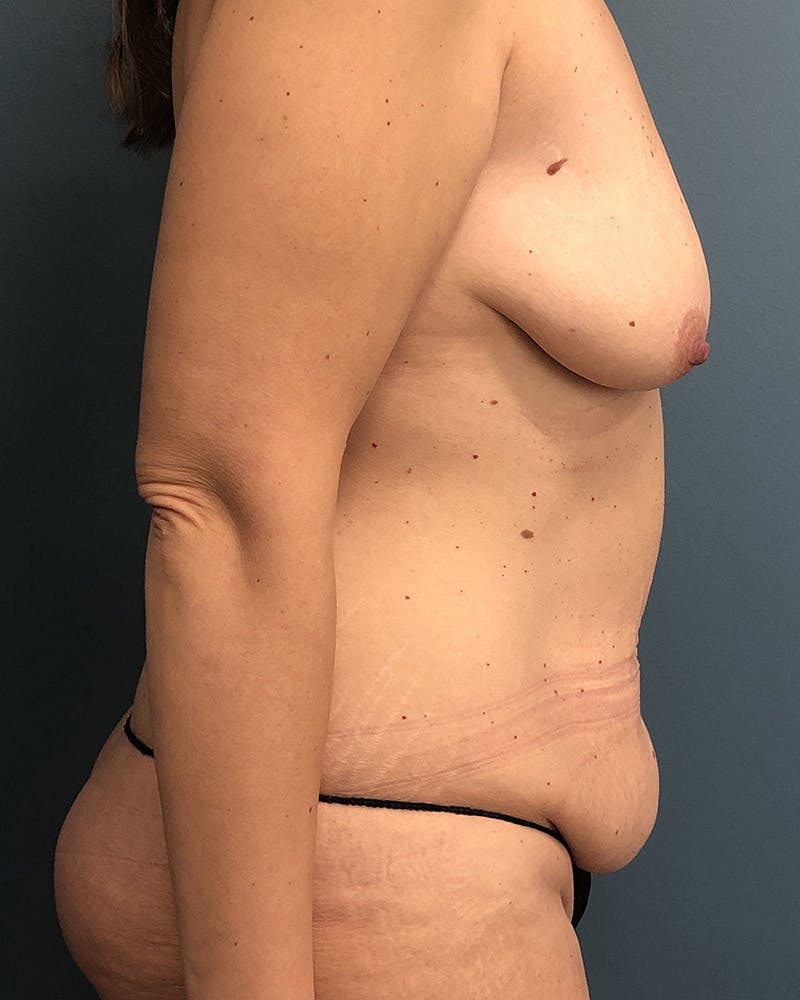 Mommy Makeover Before & After Gallery - Patient 104356 - Image 3