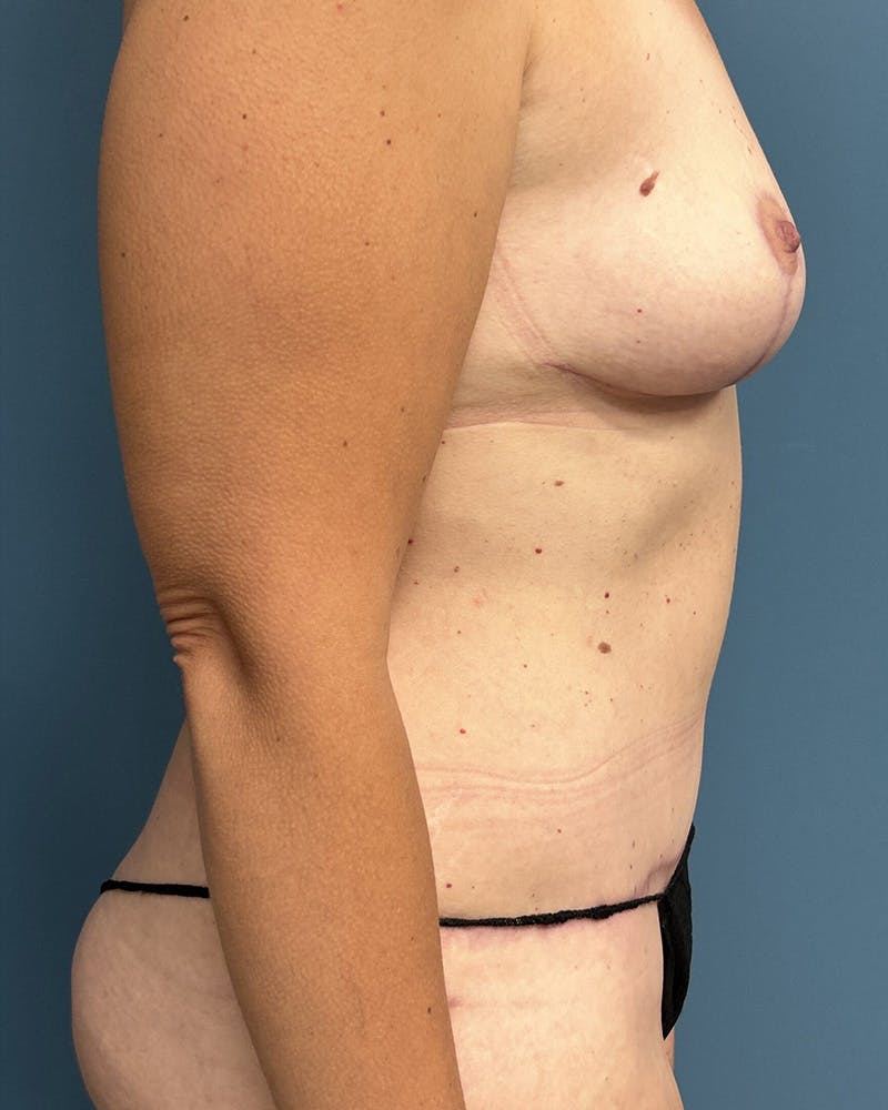 Mommy Makeover Before & After Gallery - Patient 104356 - Image 4