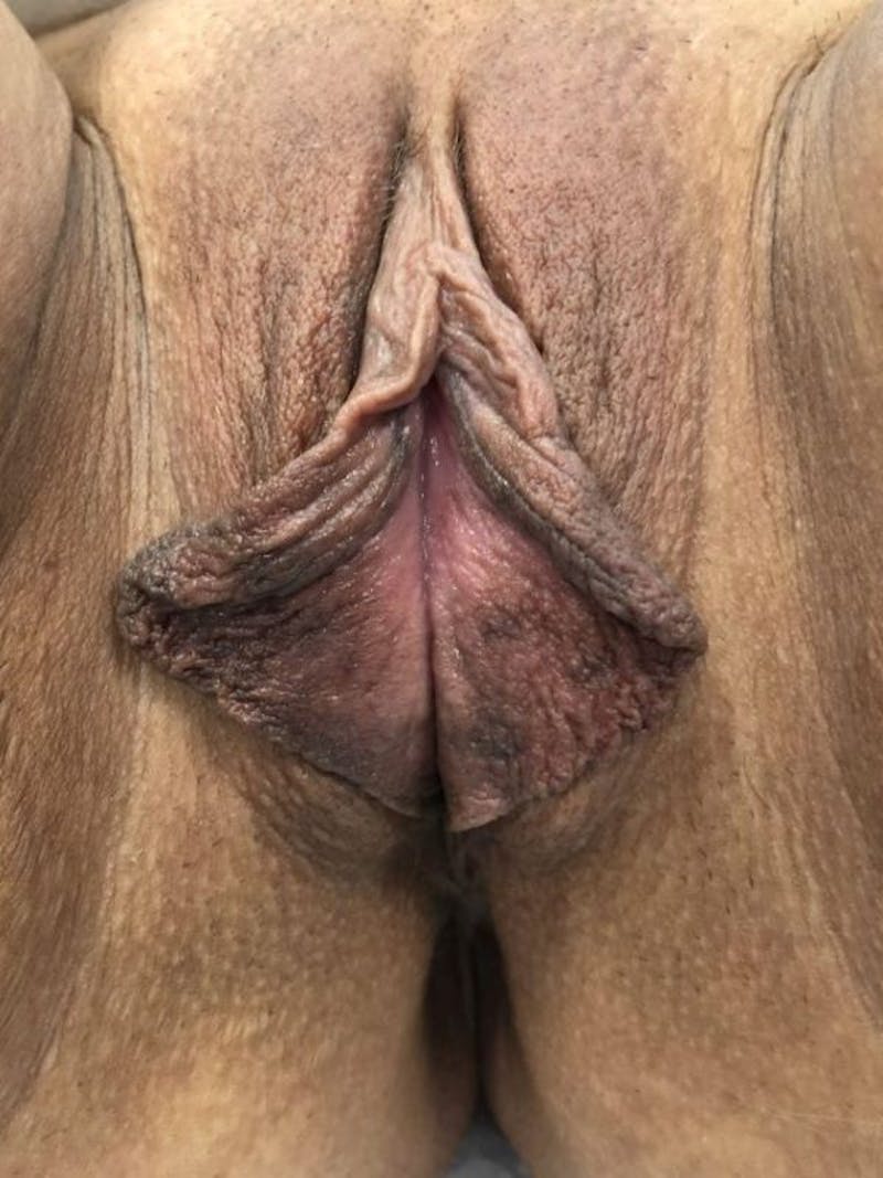 Labiaplasty Before & After Gallery - Patient 400214 - Image 1