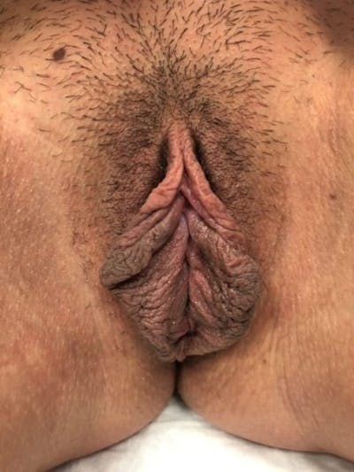 Labiaplasty Before & After Gallery - Patient 381334 - Image 1