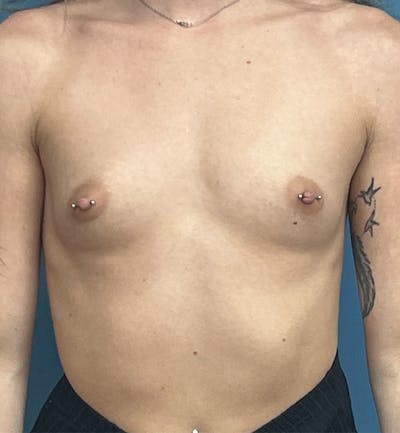 Breast Augmentation Before & After Gallery - Patient 280330 - Image 1