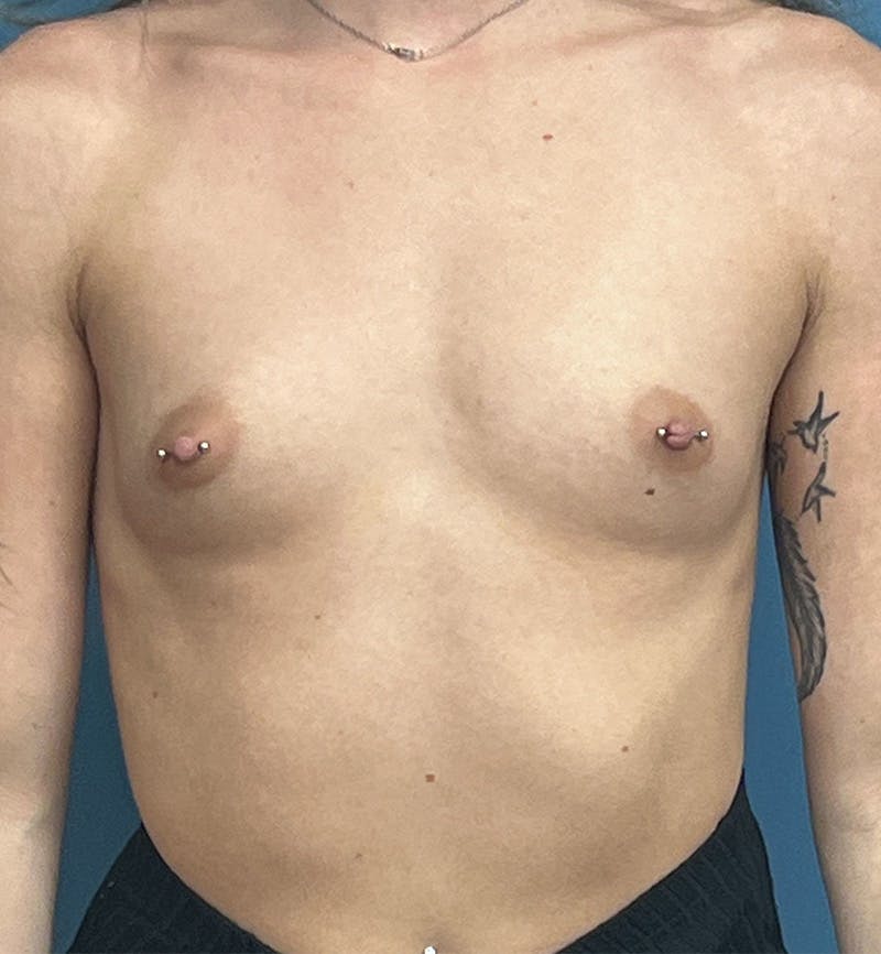 Breast Augmentation Before & After Gallery - Patient 280330 - Image 1