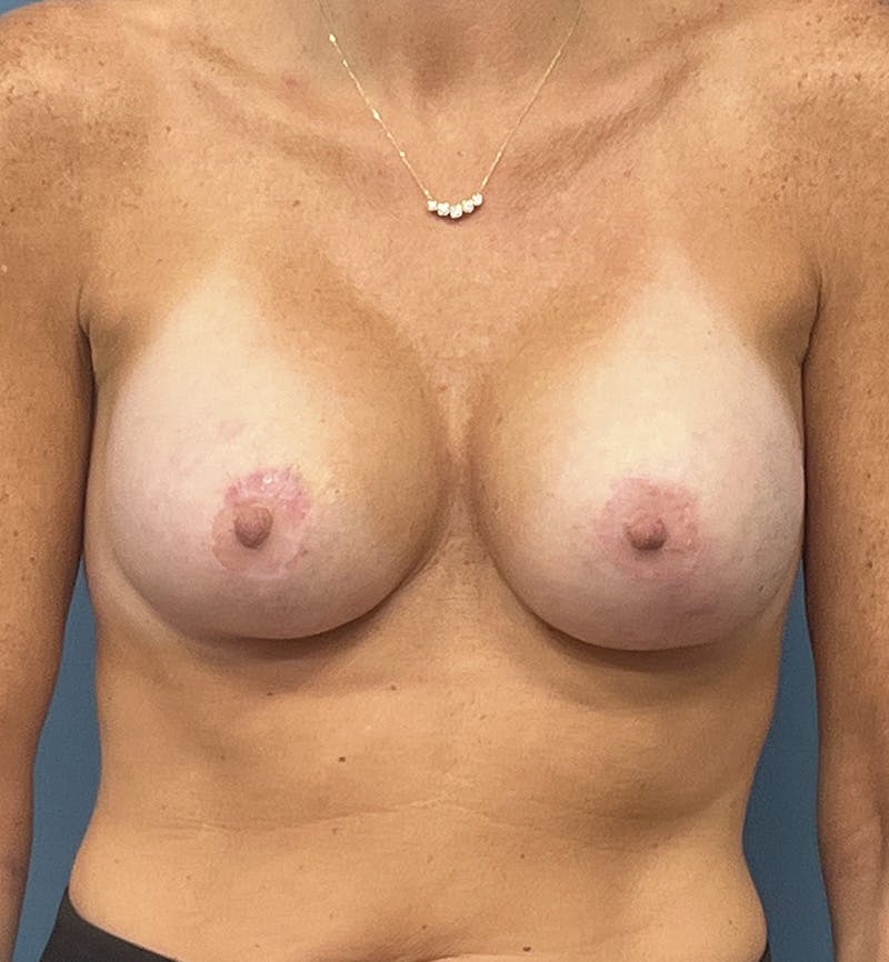 Breast Augmentation with Lift Before & After Gallery - Patient 418979 - Image 2