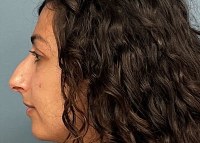 Rhinoplasty Before & After Gallery - Patient 161646 - Image 1