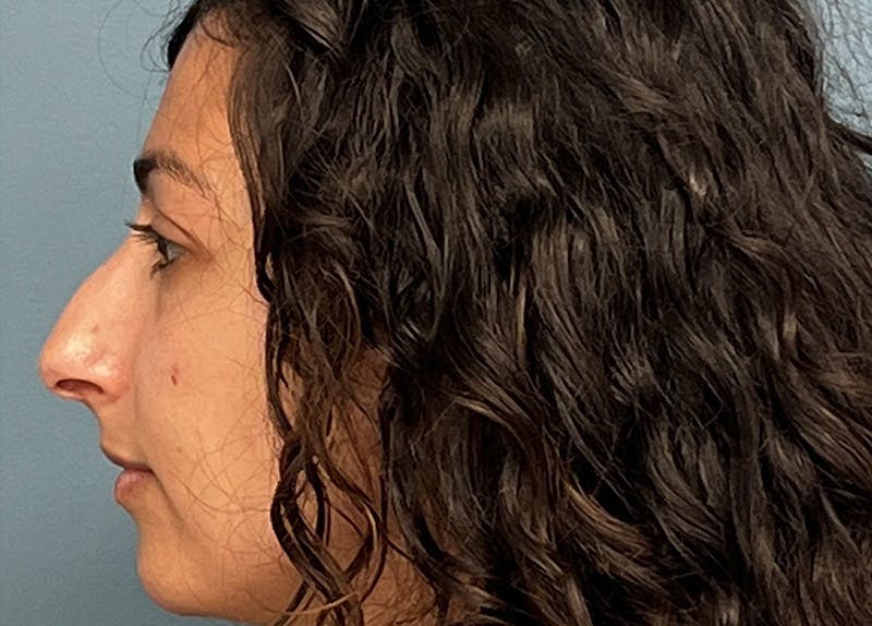 Rhinoplasty Before & After Gallery - Patient 161646 - Image 1