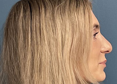Rhinoplasty Before & After Gallery - Patient 557005 - Image 1