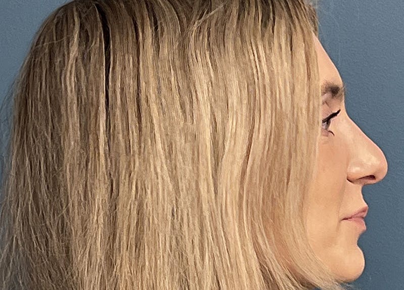 Rhinoplasty Before & After Gallery - Patient 557005 - Image 1