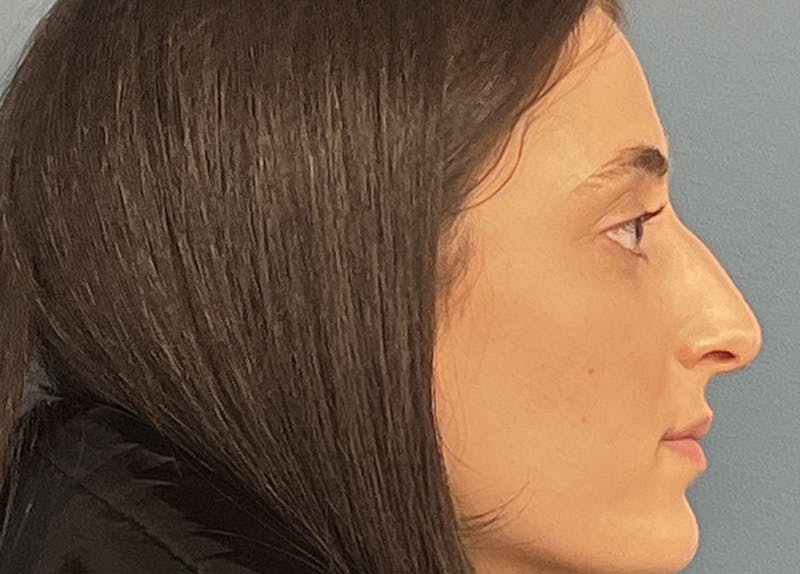 Rhinoplasty Before & After Gallery - Patient 240457 - Image 1