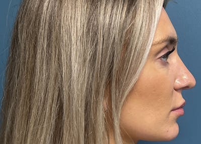 Rhinoplasty Before & After Gallery - Patient 557005 - Image 2