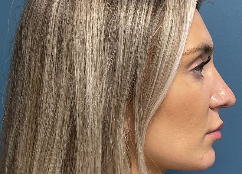 Rhinoplasty Before & After Gallery - Patient 557005 - Image 2