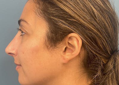 Rhinoplasty Before & After Gallery - Patient 161646 - Image 2