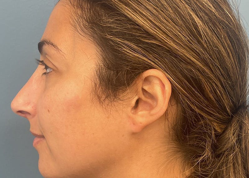 Rhinoplasty Before & After Gallery - Patient 161646 - Image 2