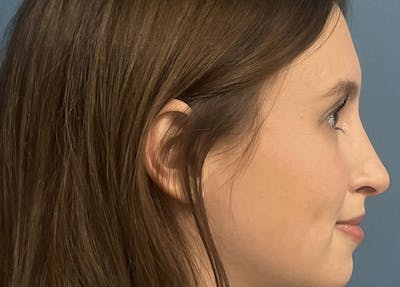 Rhinoplasty Before & After Gallery - Patient 554302 - Image 2