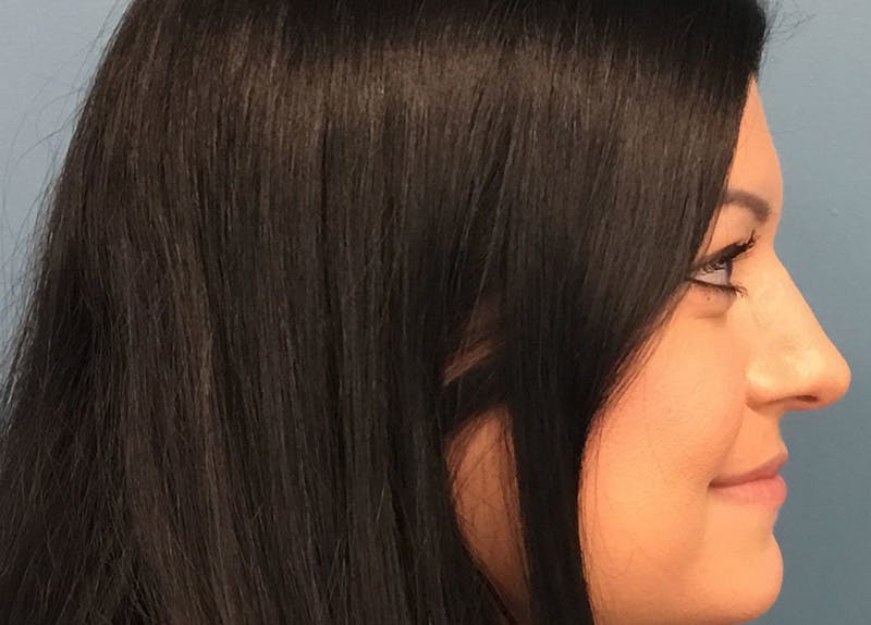 Rhinoplasty Before & After Gallery - Patient 426798 - Image 2