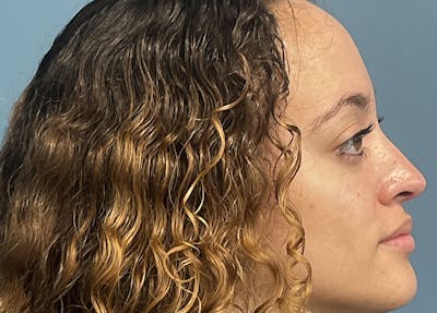 Rhinoplasty Before & After Gallery - Patient 148440 - Image 2
