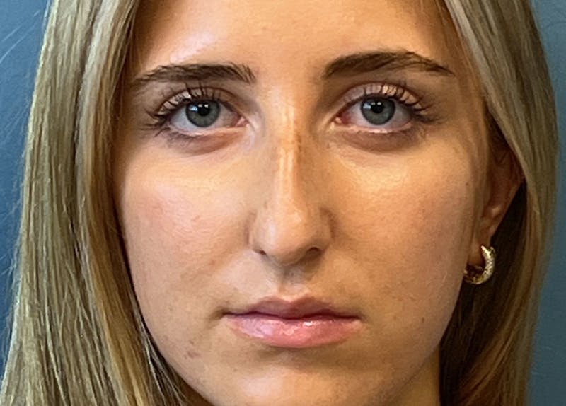 Rhinoplasty Before & After Gallery - Patient 356004 - Image 3