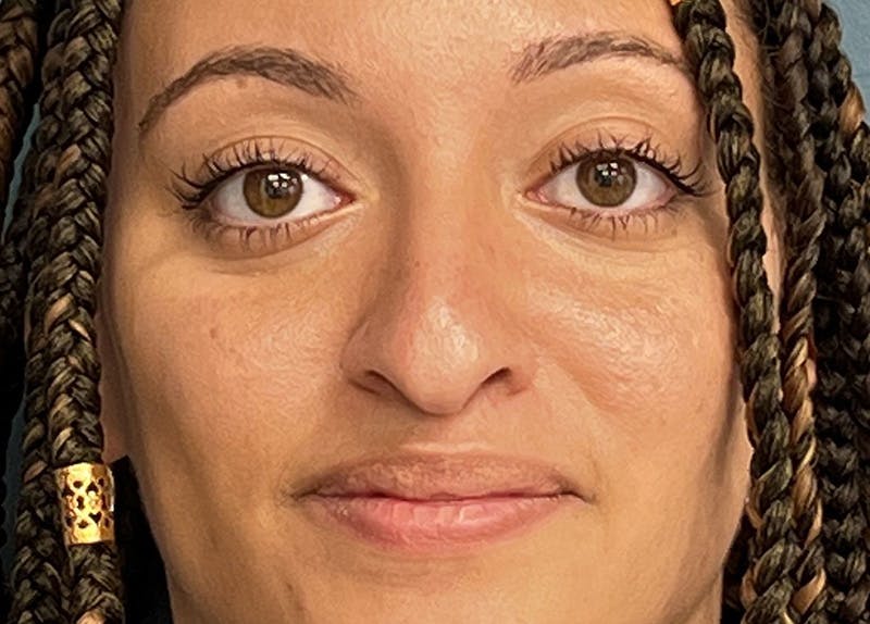 Rhinoplasty Before & After Gallery - Patient 148440 - Image 3