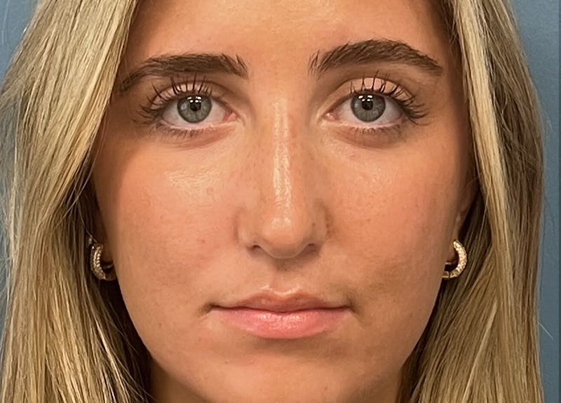 Rhinoplasty Before & After Gallery - Patient 356004 - Image 4