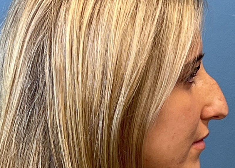 Rhinoplasty Before & After Gallery - Patient 356004 - Image 1