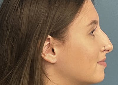 Rhinoplasty Before & After Gallery - Patient 554302 - Image 1