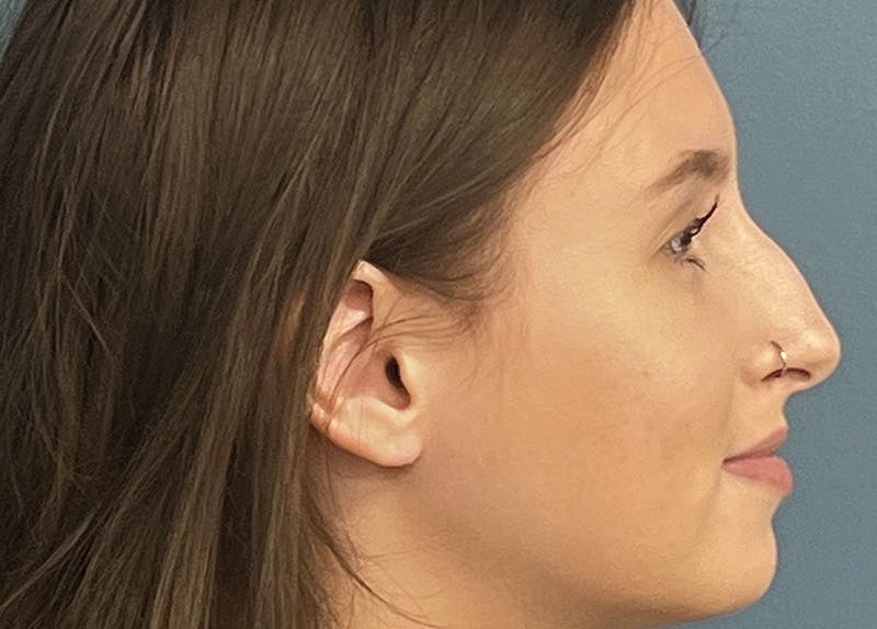Rhinoplasty Before & After Gallery - Patient 554302 - Image 1
