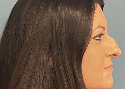 Rhinoplasty Before & After Gallery - Patient 426798 - Image 1