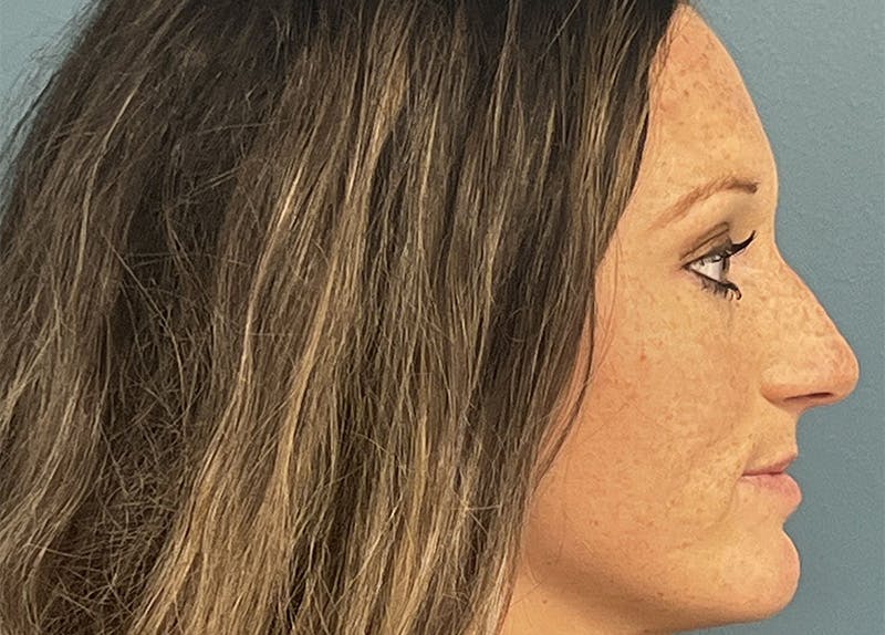 Rhinoplasty Before & After Gallery - Patient 279269 - Image 1