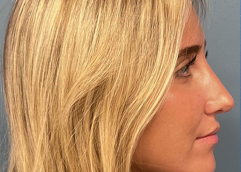Rhinoplasty Before & After Gallery - Patient 356004 - Image 2