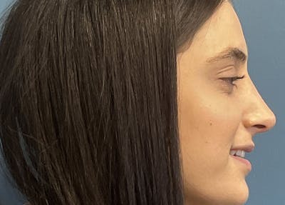 Rhinoplasty Before & After Gallery - Patient 240457 - Image 2